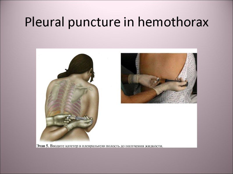 Pleural puncture in hemothorax